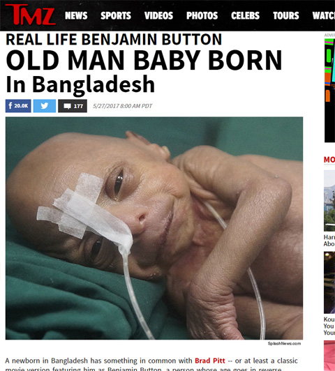 リアル ベンジャミン バトン 老人のような赤ちゃんが患う プロジェリア症候群 とは 海外ドラマ セレブニュース Tvグルーヴ